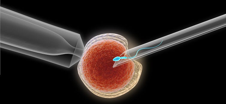  PROCEDURE. In the intracytoplasmic sperm injection process, a single sperm is injected directly into an egg. medistock/Shutterstock.com