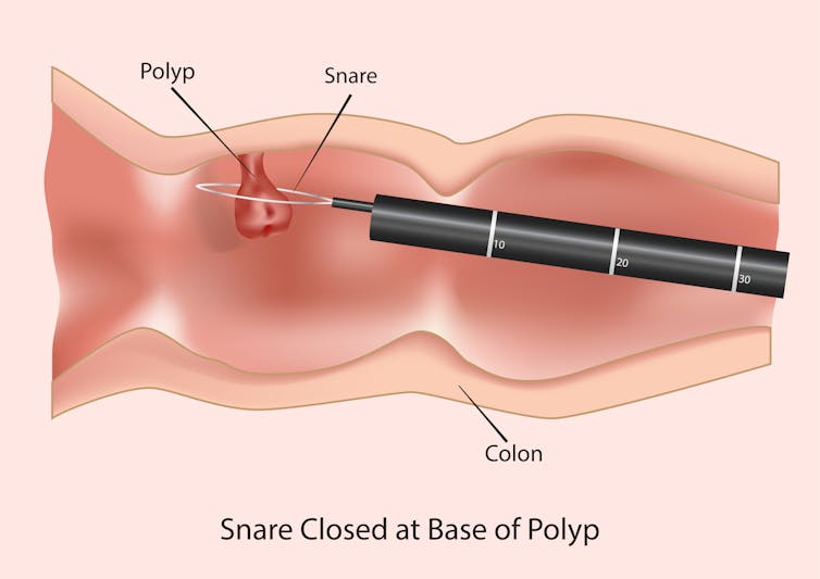 Colorectal cancer increase in younger adults: What could be the cause?