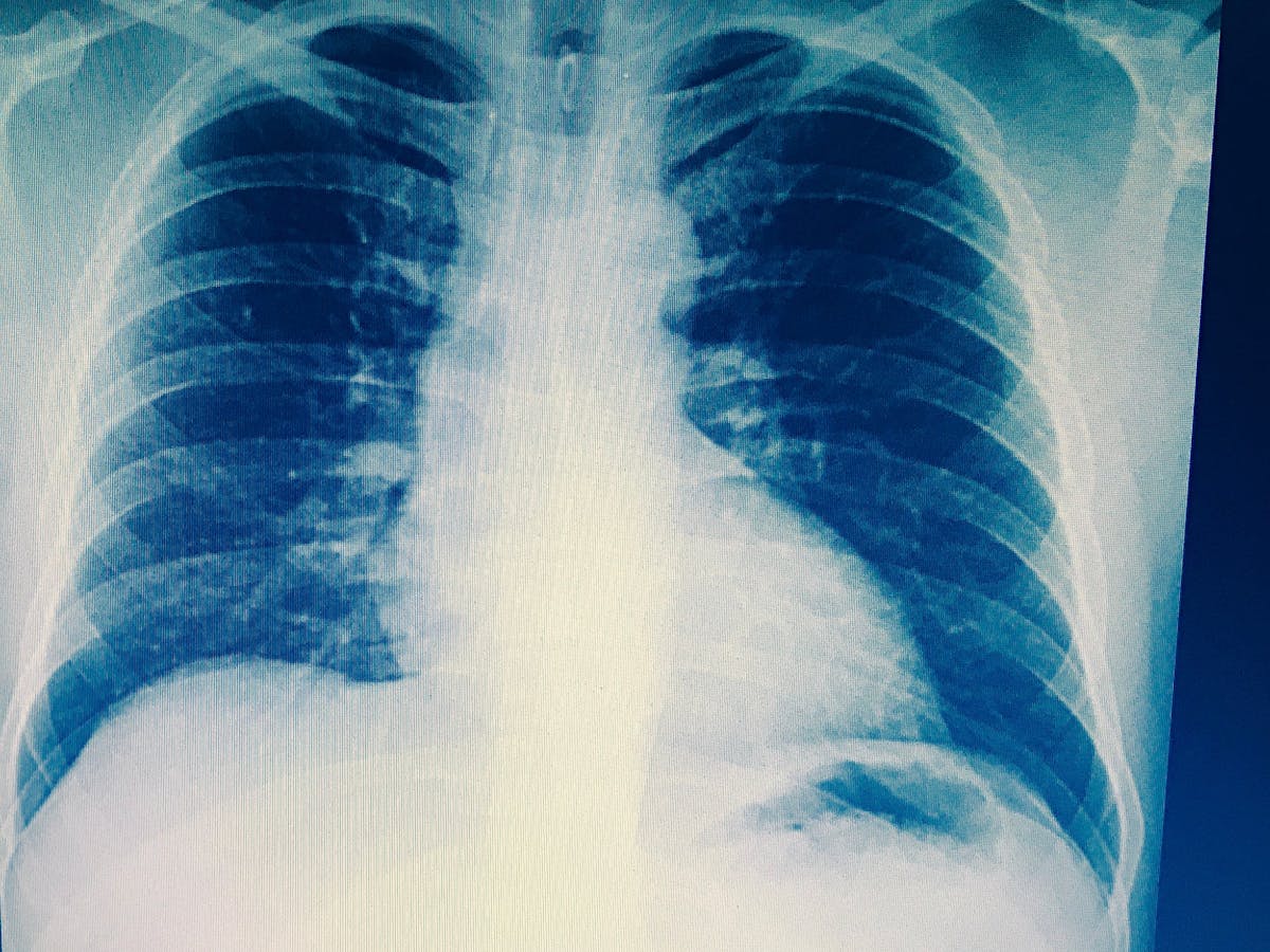 Scientists Are Developing New Exciting Strategies For The Fight Against Tb