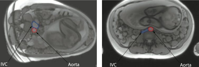 IMAGES. The MRI images show the inferior vena cava (IVC) in blue and the aorta in red. In the left image, the mother is lying on her left side, while in the right image, she is on her back. provided, CC BY-SA