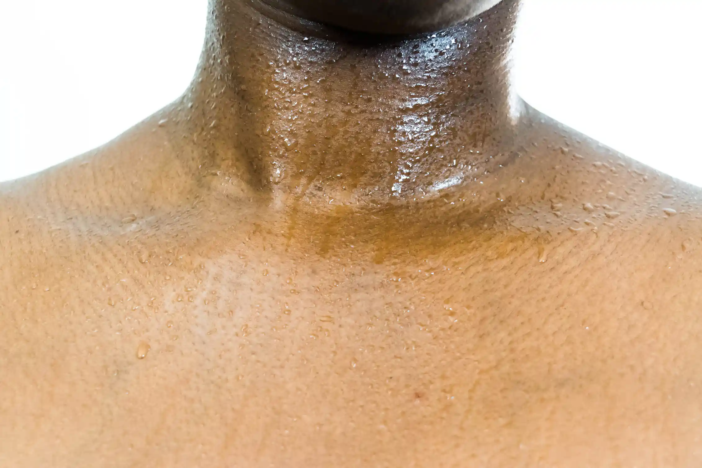 Hyperhidrosis: the excessive sweating condition that could ruin your life