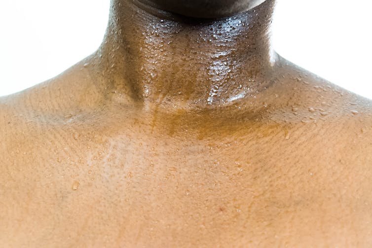 Red And Sweating The Sweating Condition That Could Ruin Your Life | RealClearScience