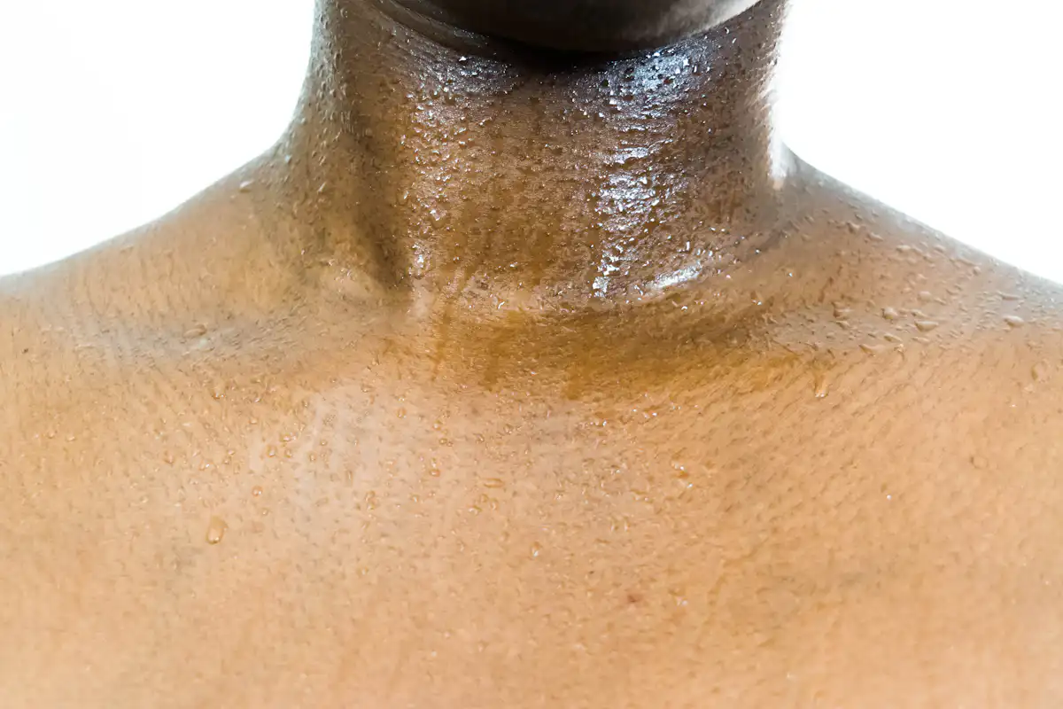 Hyperhidrosis: the excessive sweating condition that could ruin your life