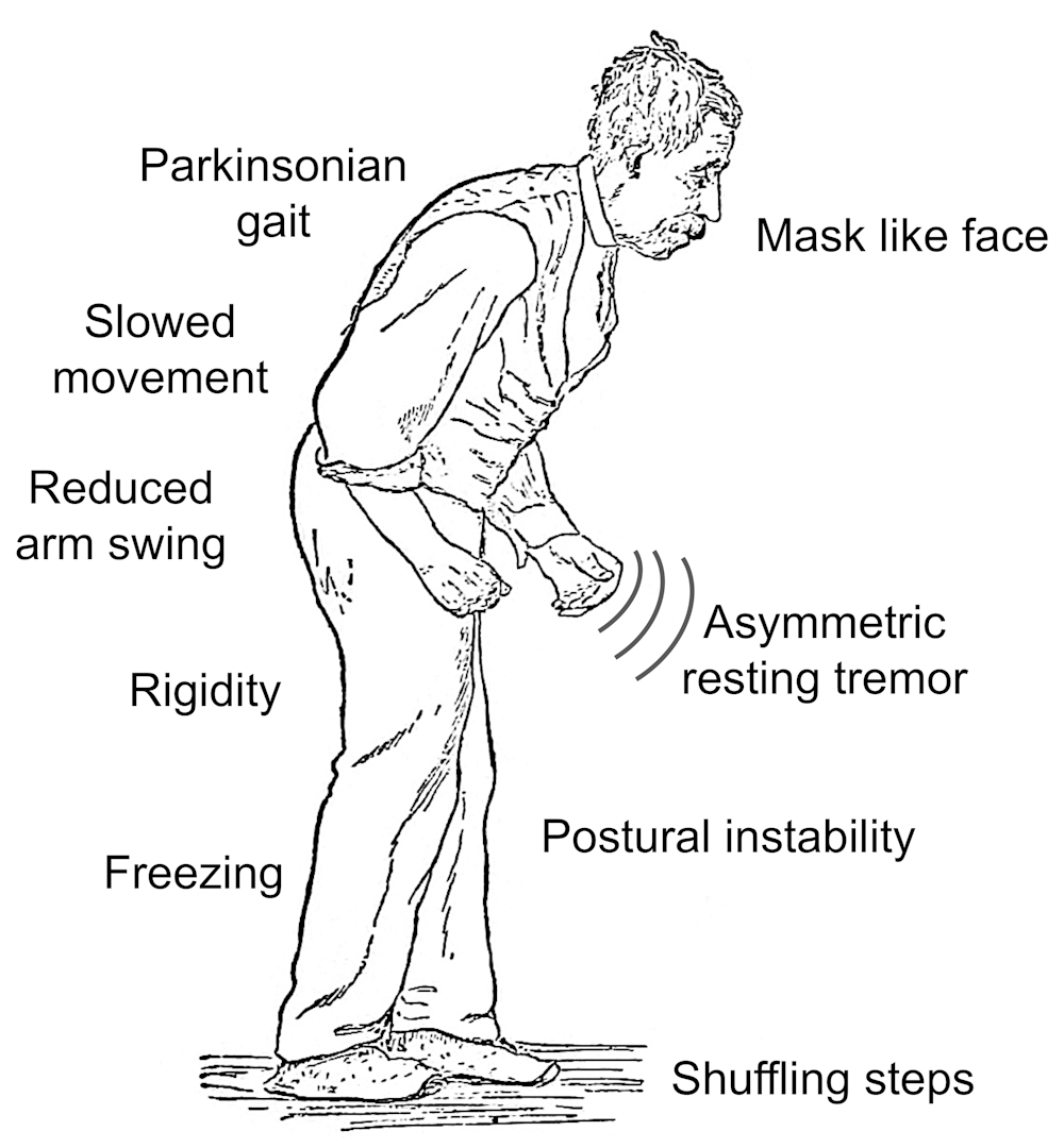 New symptoms of earlyonset Parkinson’s cause a stir