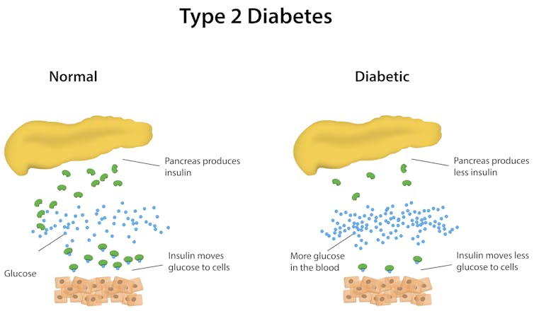 managing type 2 diabetes during Ramadan