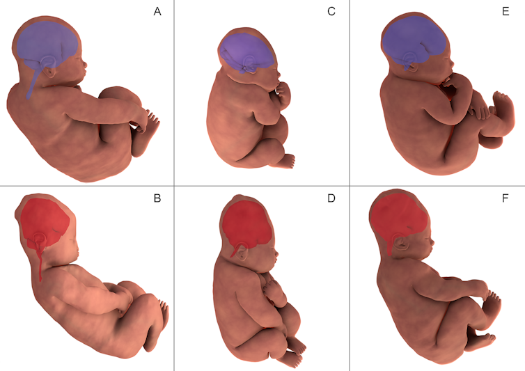 La reconstrucción tridimensional de la resonancia cerebral fetal muestra la forma del cerebro de un bebé antes de parto (en morado en las imágenes A, C y E) y durante la segunda etapa del parto (en naranja en las imágenes B, D y F). Imagen: Olivier Amie and co-authors