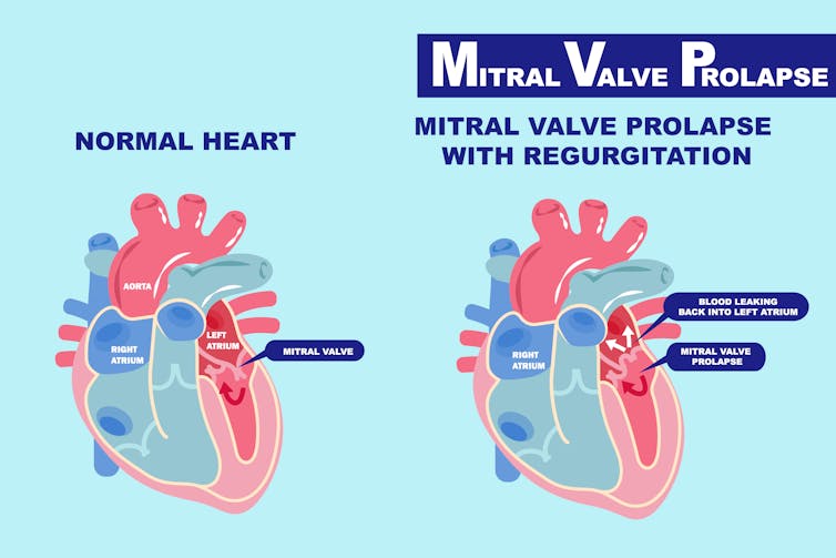 Genetic trigger discovered for common heart problem, mitral valve prolapse