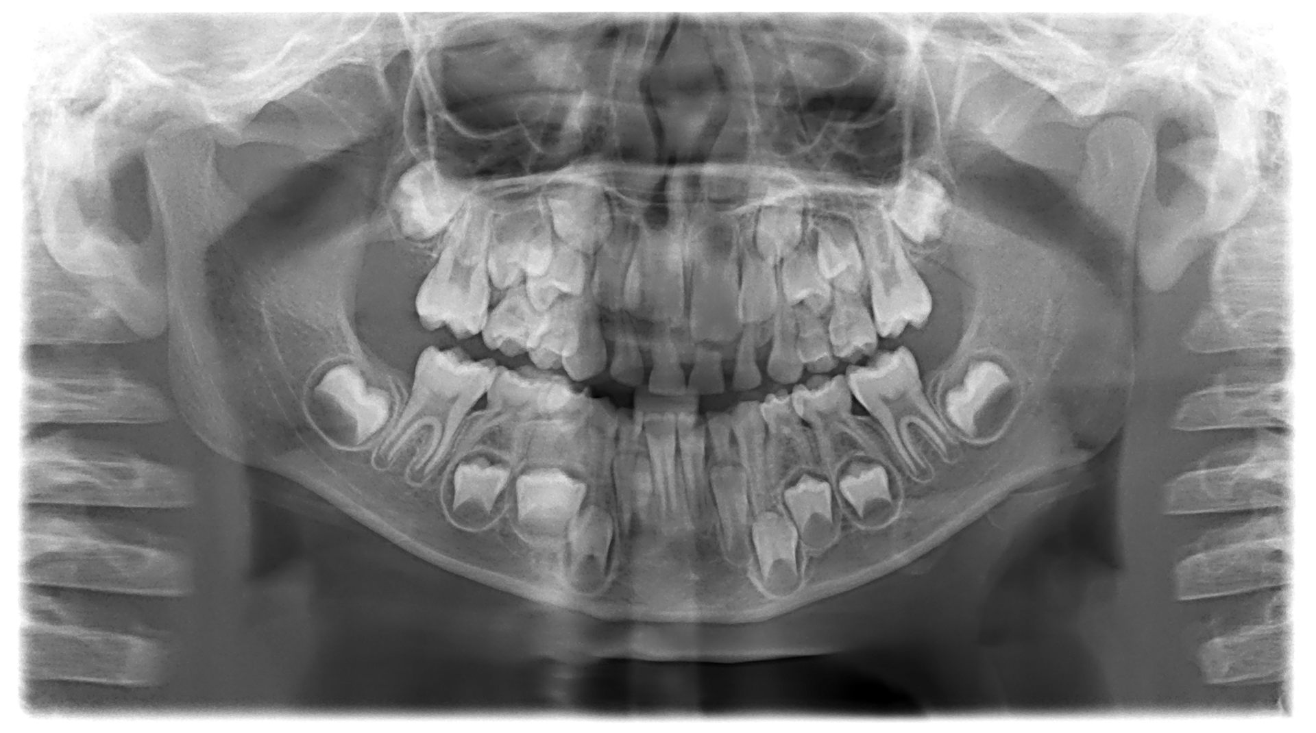 Рентген головы младенца зубов