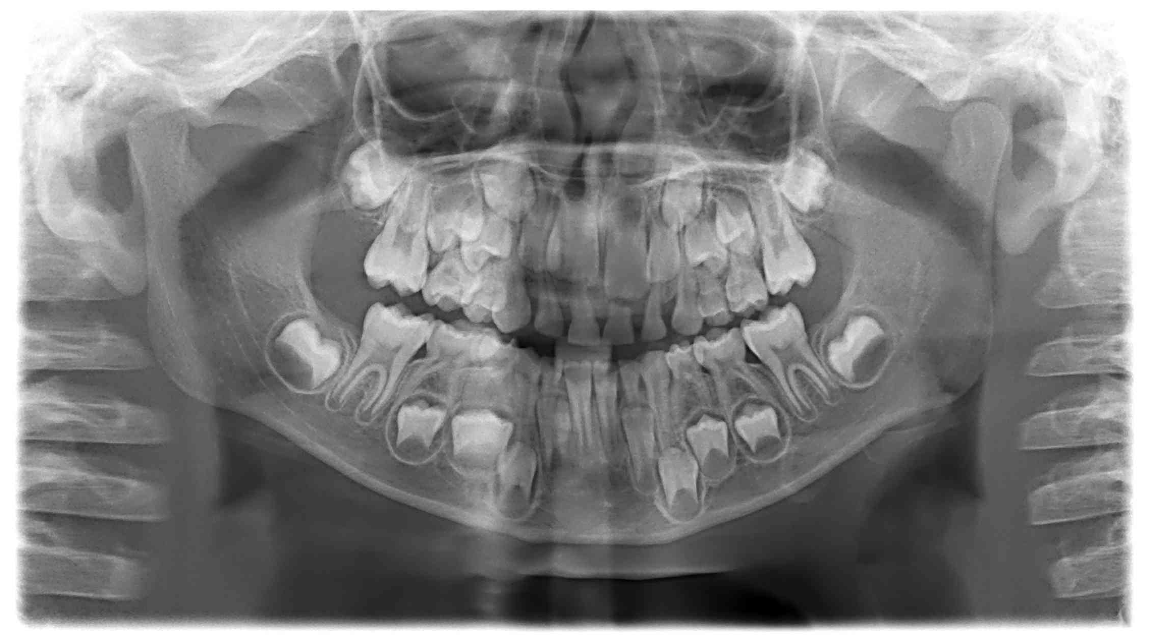 Детский череп рентген. Снимок молочных и коренных зубов. Панорамный снимок челюсти.