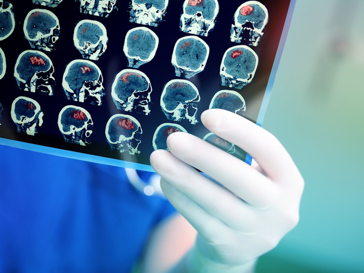 Vacuum Cleaner Untuk Otak Cerita Dokter Inggris Yang Obati Stroke Vacuum Cleaner Untuk Otak Cerita Dokter Inggris Yang Obati Stroke