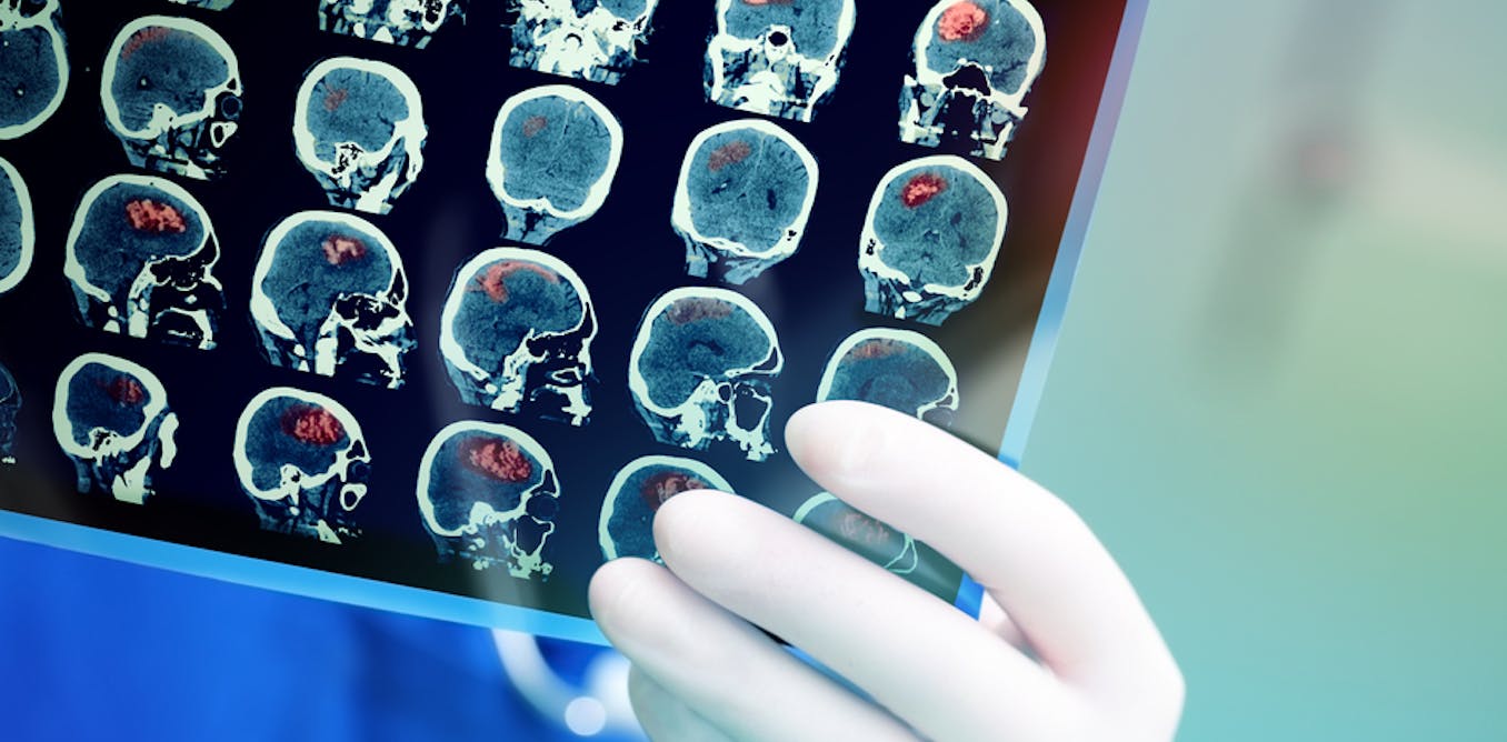 Vacuum Cleaner Untuk Otak Cerita Dokter Inggris Yang Obati Stroke Vacuum Cleaner Untuk Otak Cerita Dokter Inggris Yang Obati Stroke