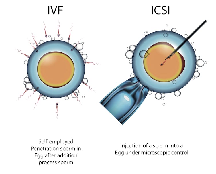 Fertility miracle or fake news? Understanding which IVF 'add-ons' really work