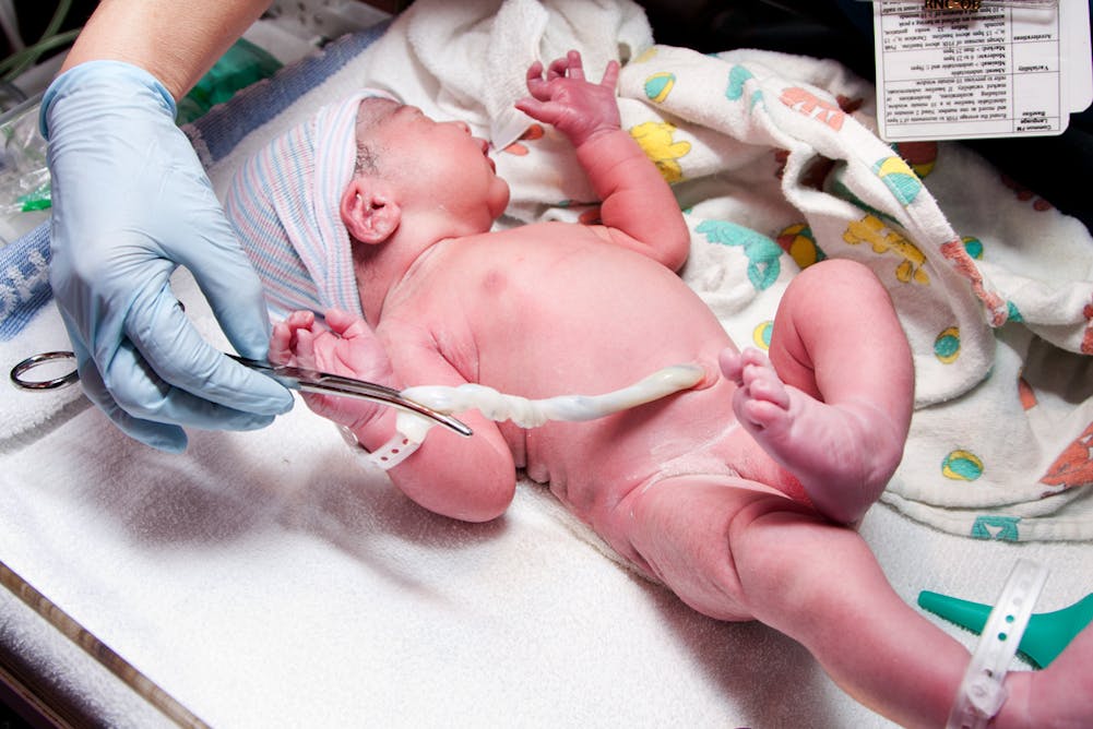 Are We Cutting Umbilical Cords Too Soon After Birth