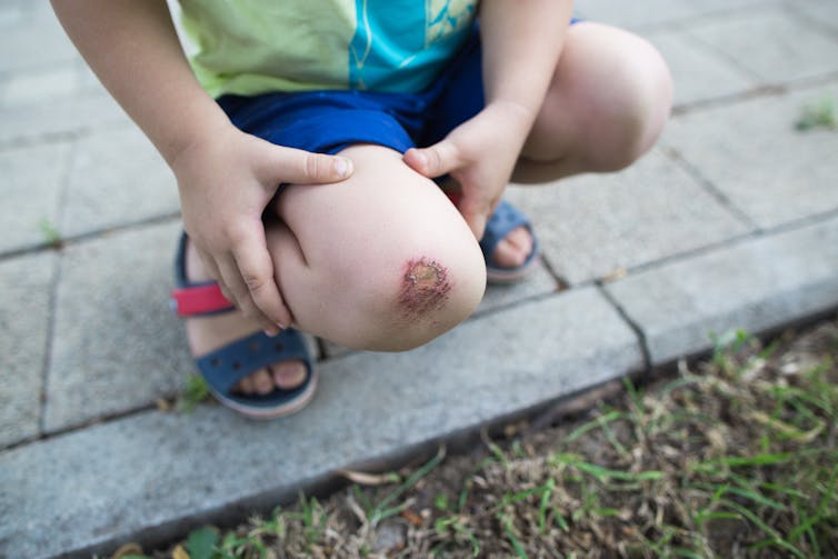 Curious Kids: how do wounds heal?