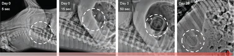 Drugs on a coil free patients from the burden of taking pills for treating infectious diseases