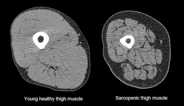 The muscle-wasting condition 'sarcopenia' is now a recognised disease. But we can all protect ourselves