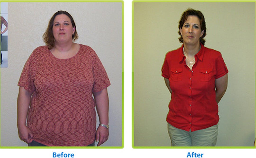 Вес после бариатрической операции. До и после бариатрической операции. Резекция желудка для похудения. Похудение после бариатрической операции.