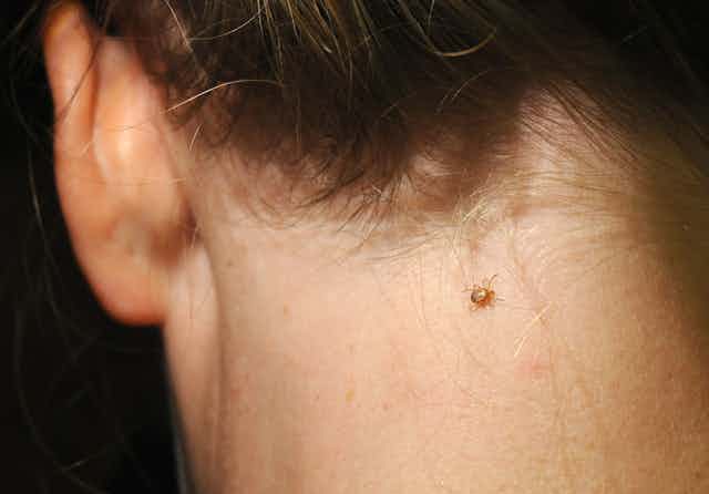 Ticks spread plenty more for you to worry about beyond Lyme disease