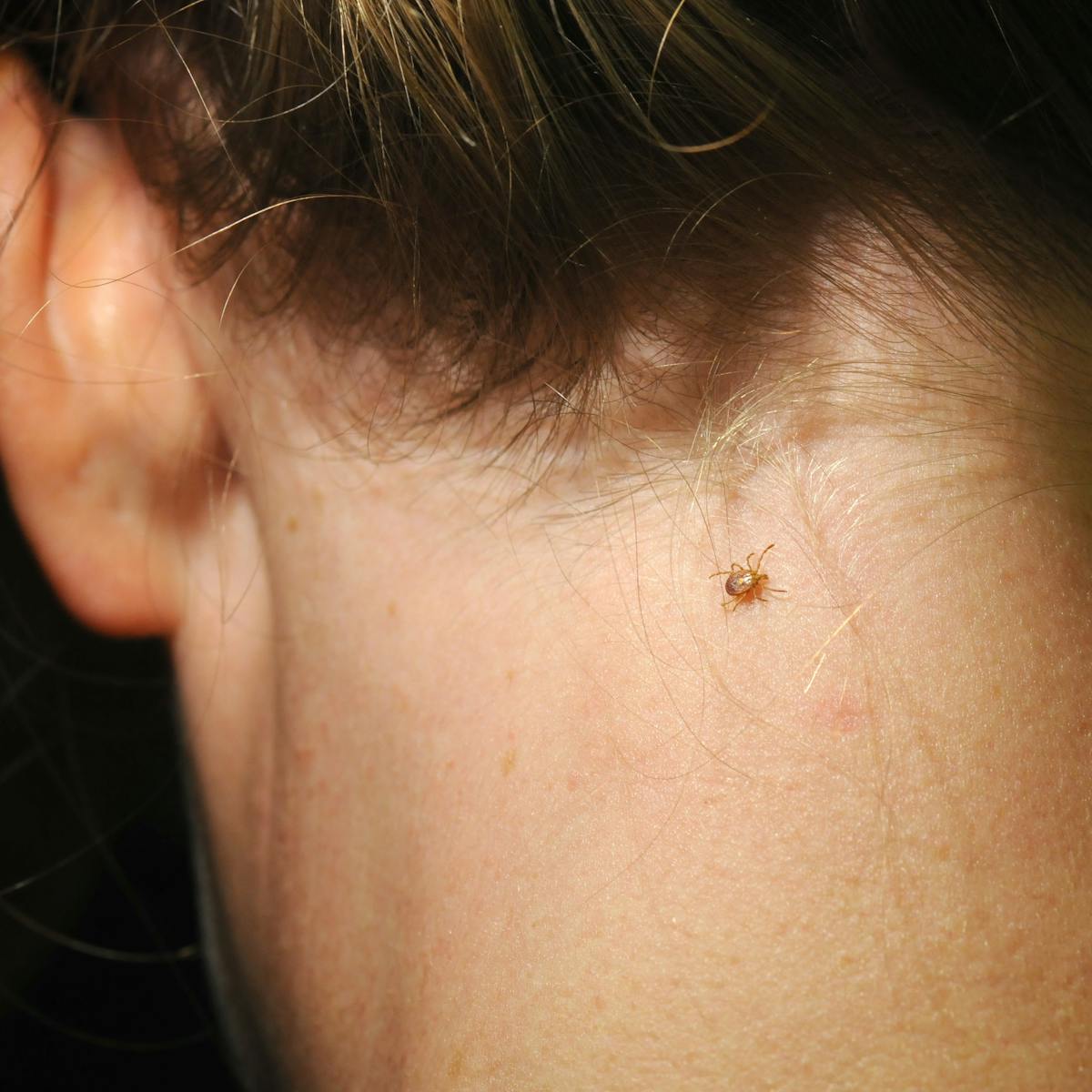 Ticks spread plenty more for you to worry about beyond Lyme disease