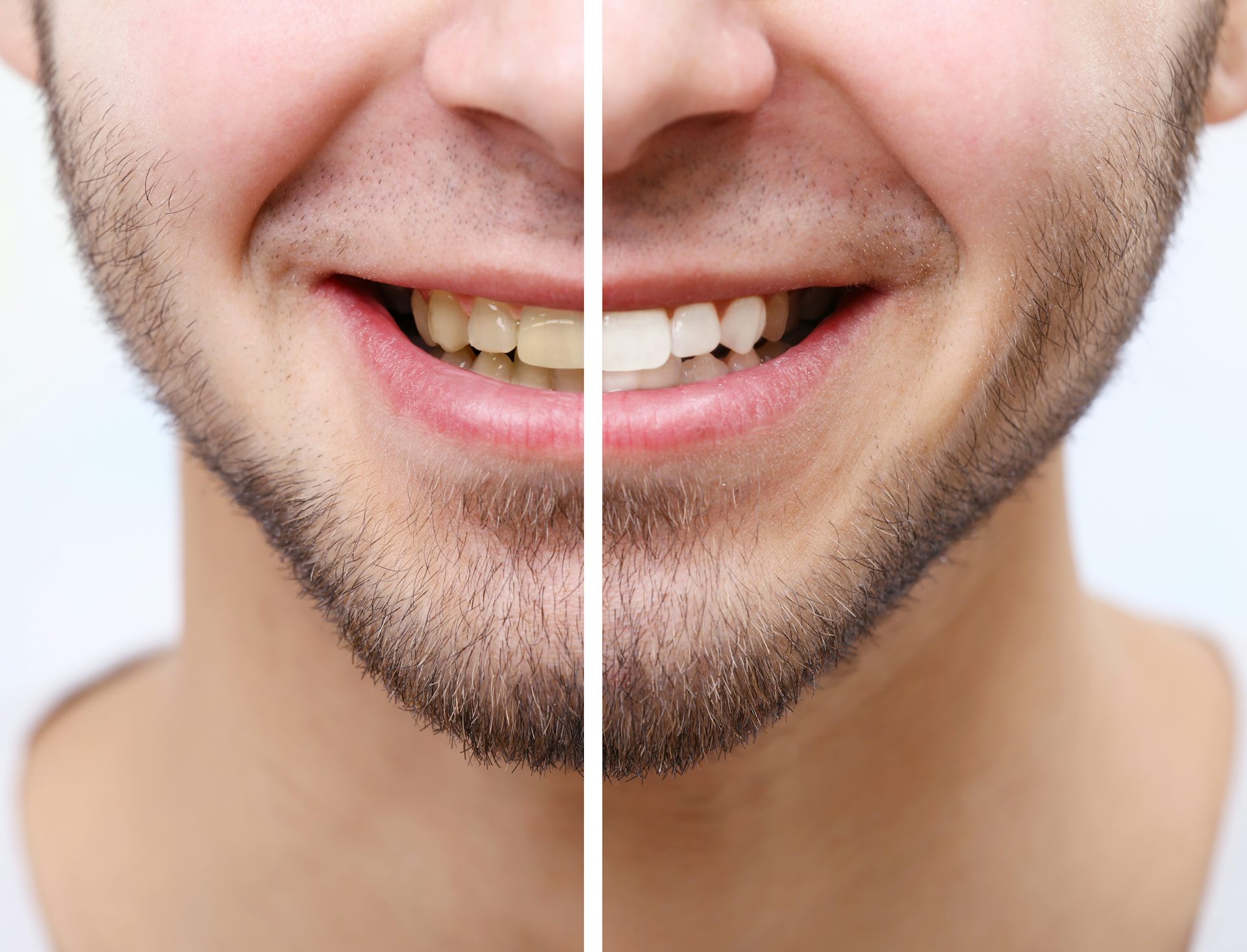 Is whitening bad for teeth We asked five experts