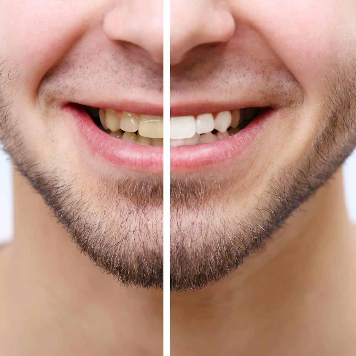 Is Whitening Bad For Teeth We Asked Five Experts