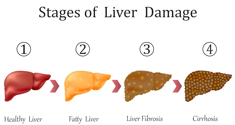 How to grow human mini-livers in the lab to help solve liver disease