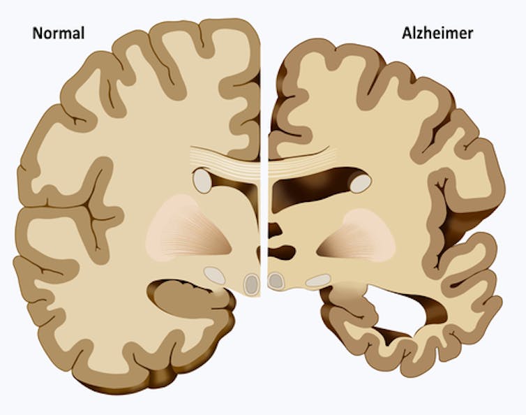 Blood tests for Alzheimer’s: Two experts on why new studies are encouraging