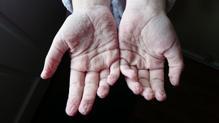 Curious Kids: why do our toes and fingers get wrinkly in the bath?