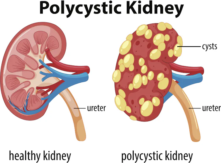 Polycystic kidney disease, the most common genetic kidney disorder you've probably never heard of Polycystic kidney disease, the most common genetic kidney disorder you've probably never heard of