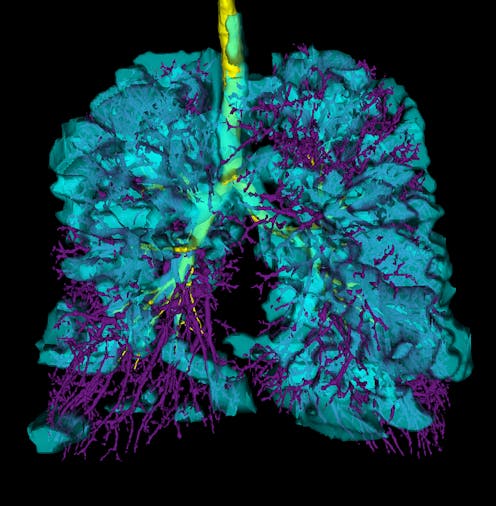 Vapotage Des Effets Devastateurs A Craindre Pour Les Poumons Vapotage Des Effets Devastateurs A Craindre Pour Les Poumons