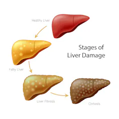 Diagram depicting a deterirating liver, going from healthy liver to fatty liver to liver fibrosis to cirrhosis