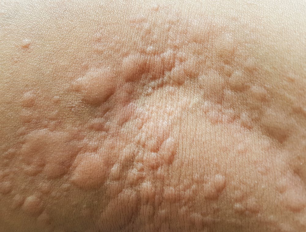 What Are Hives The Common Skin Condition That Gives You Itchy Red