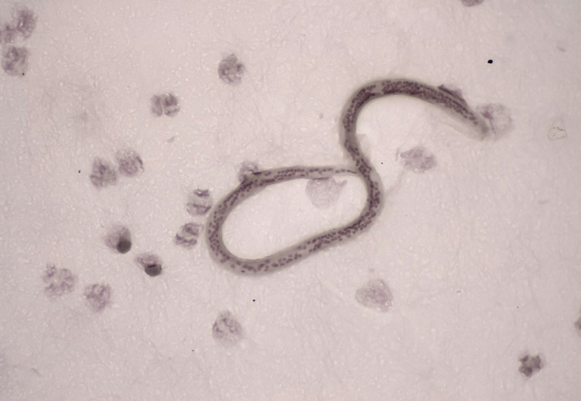 Types of human parasite Worms infections and causes