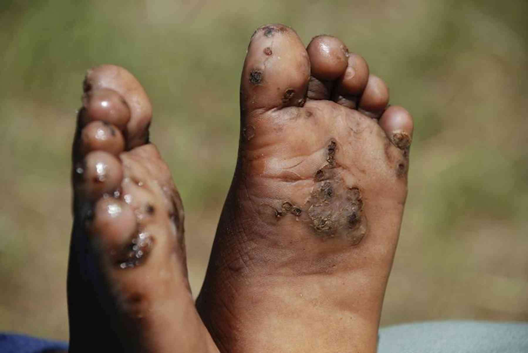 maggots in feet        <h3 class=