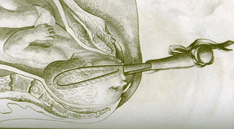 18th century illustration of forceps cradling baby's head