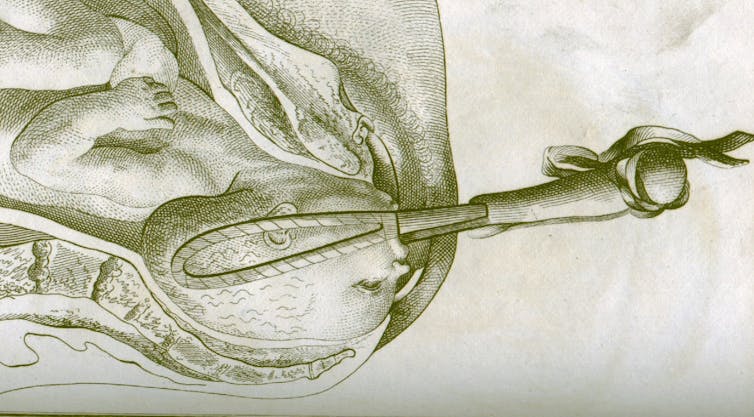 How forceps permanently changed the way humans are born