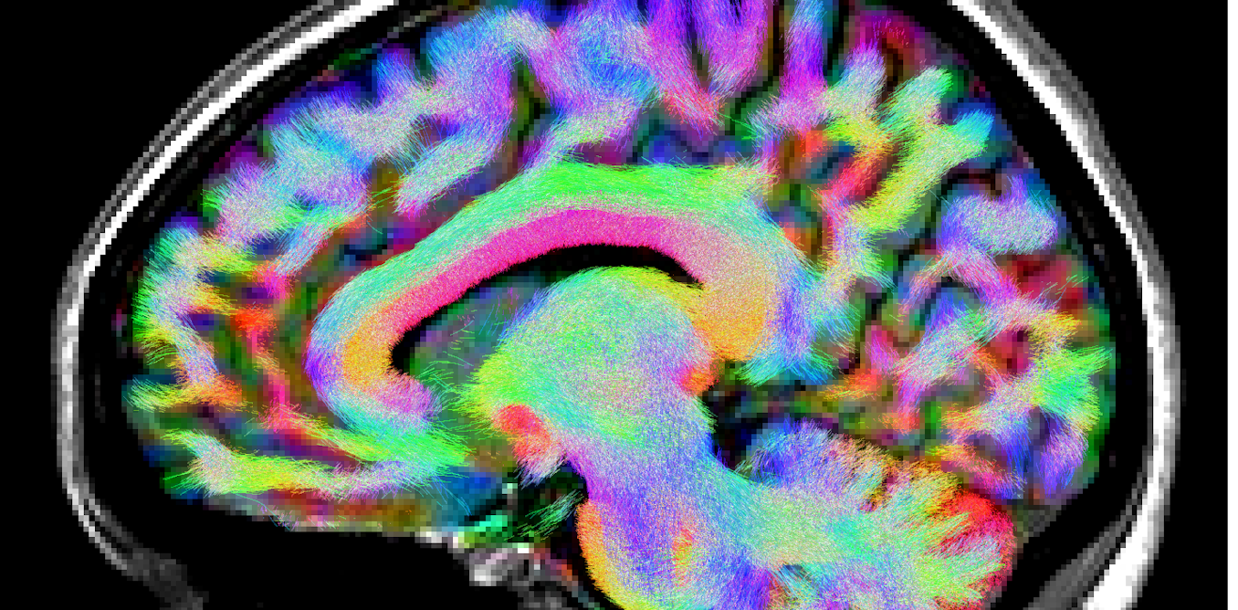Mri Brain Color