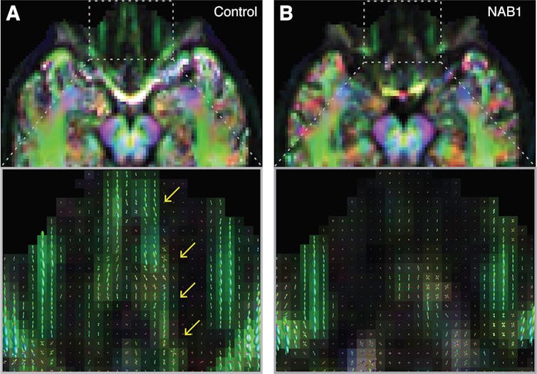 Some women seem to lack a key brain structure for smell -- but their sense of smell is fine