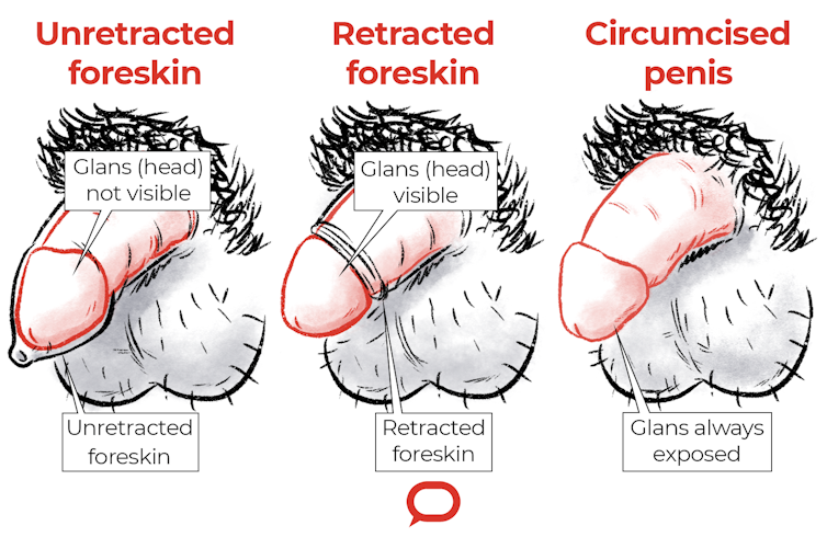 Tipuri și tipuri de penisuri - Disfuncție erectilă cu prostatită