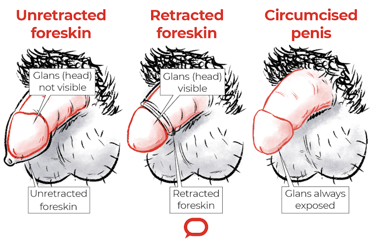 Dots around penis head