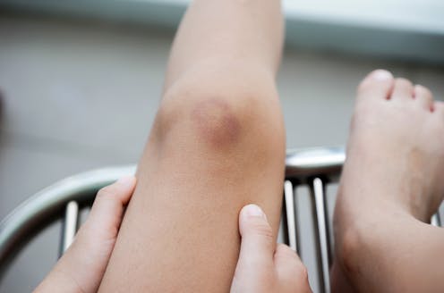 Curious Kids: why do we get bruises?