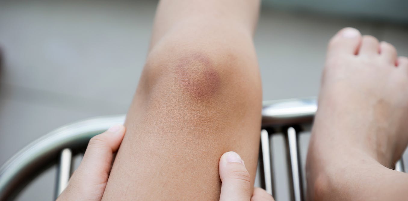 Curious Kids: why do we get bruises?