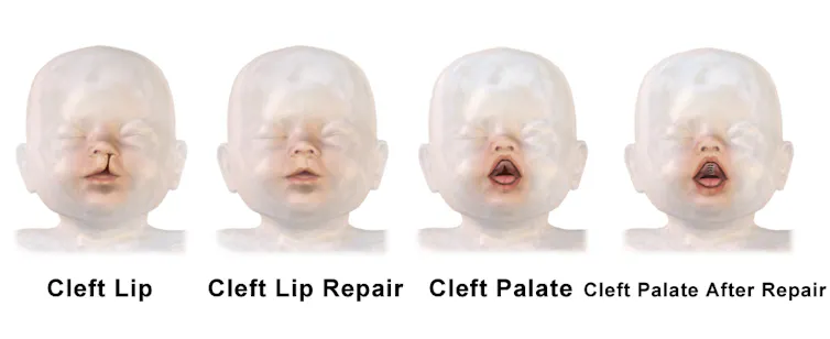 Illustration showing before and after depictions of cleft lip and cleft lip palate repair