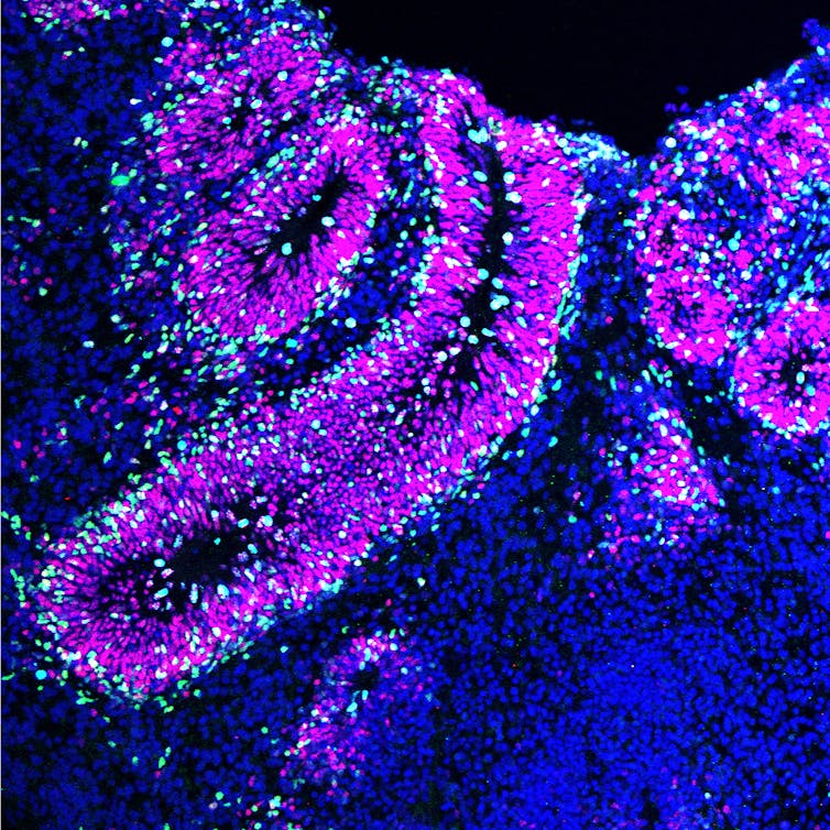 Brain organoids help neuroscientists understand brain development, but aren't perfect matches for real brains