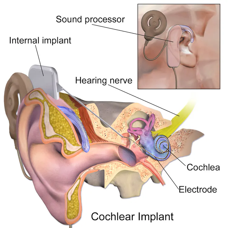 Vibration on the skin helps hearing-impaired people locate sounds Vibration on the skin helps hearing-impaired people locate sounds