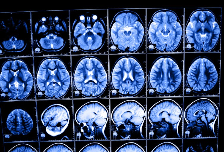 Brain temperature is difficult to measure. Here's how a new infrared technique can help