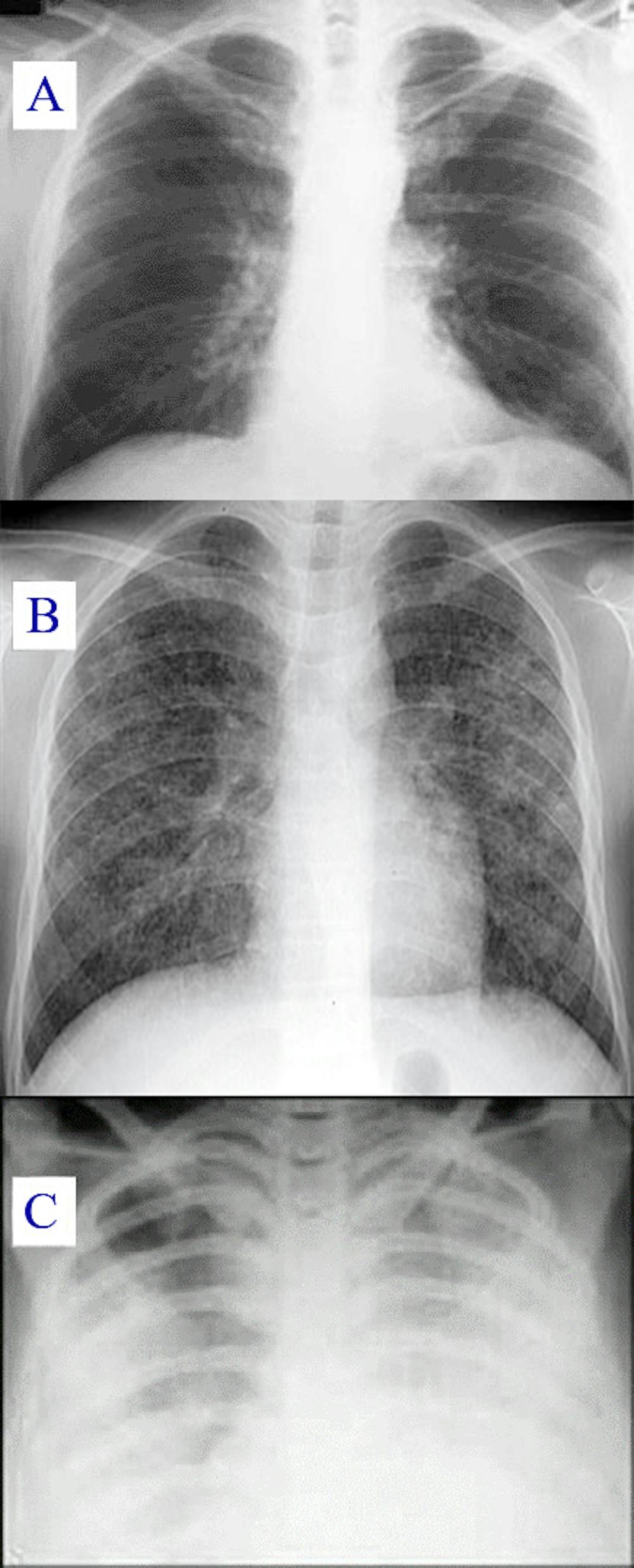 Clip pour radiographies DR Clip pour marqueurs radiologiques