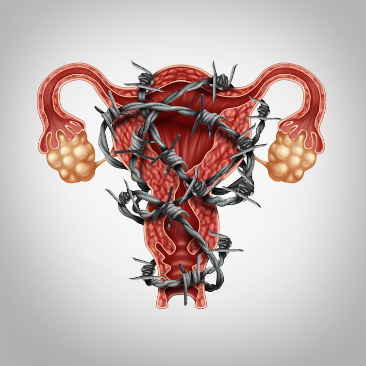 Endometriosis: una enfermedad dolorosa infradiagnosticada