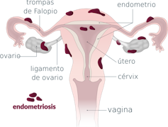 Endometriosis: una enfermedad dolorosa infradiagnosticada