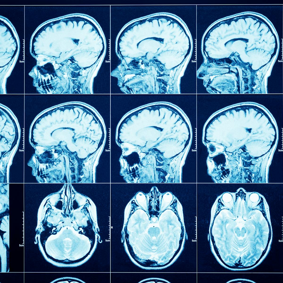 Coronavirus Many Patients Reporting Neurological Symptoms
